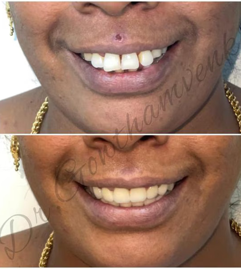 Best Dental Hospital in Chennai With Low Cost