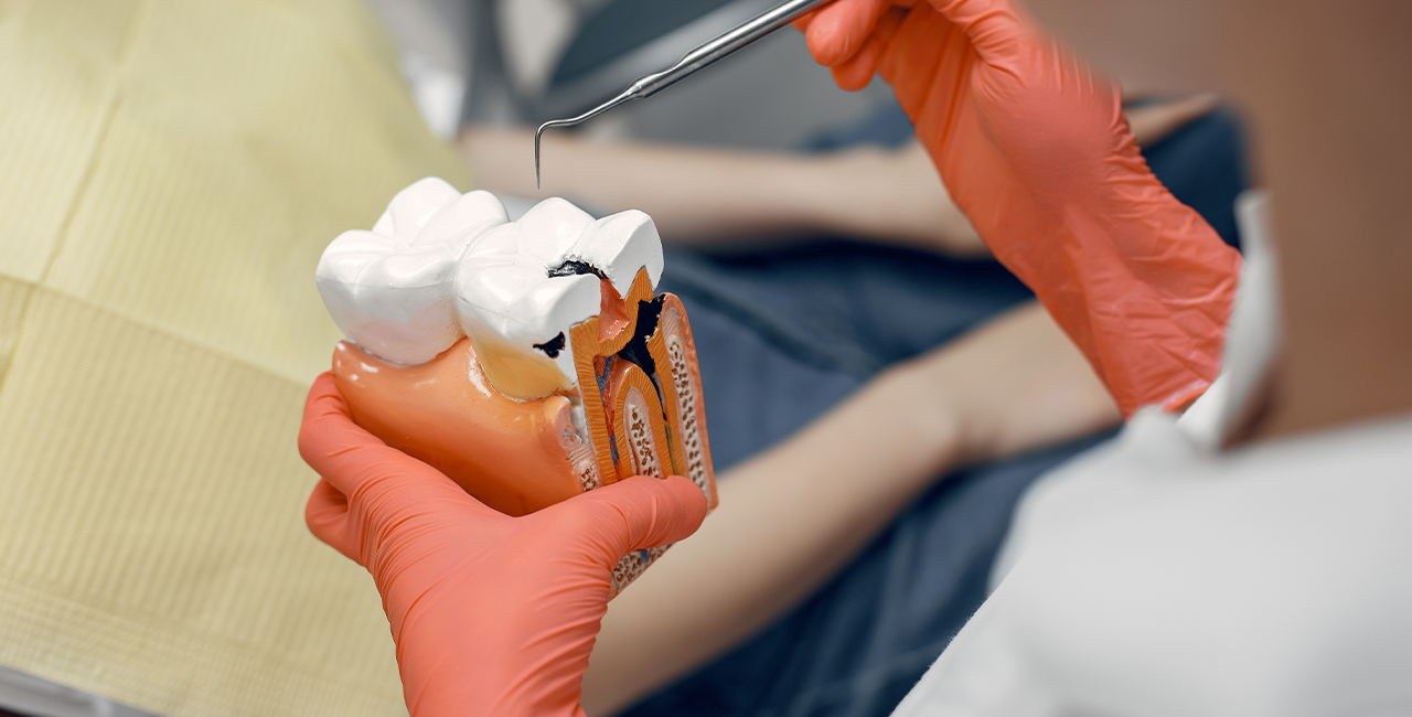 Root Canal Treatment in Vadapalani